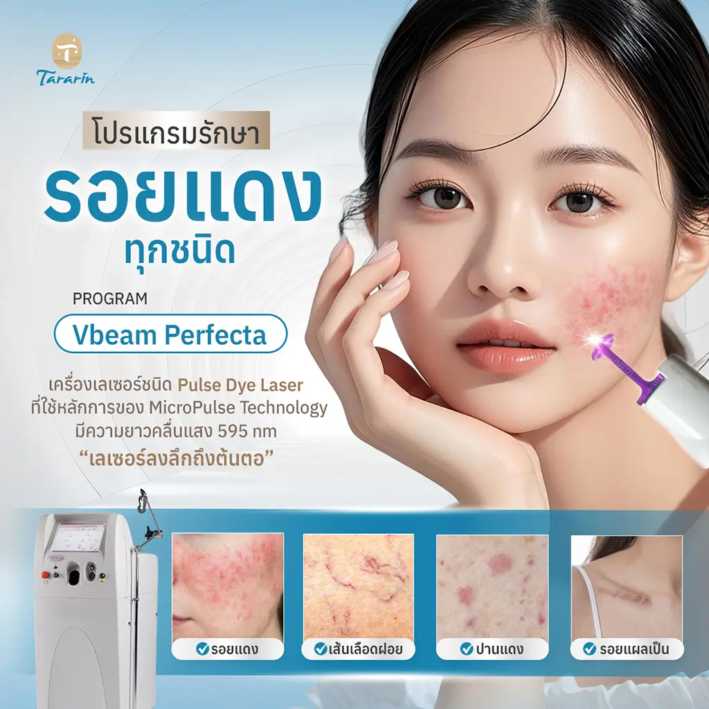 Vbeam