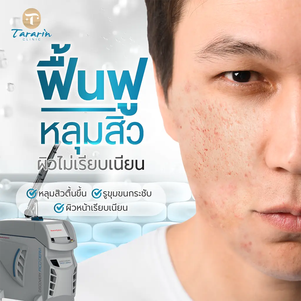 pico-acne-scar