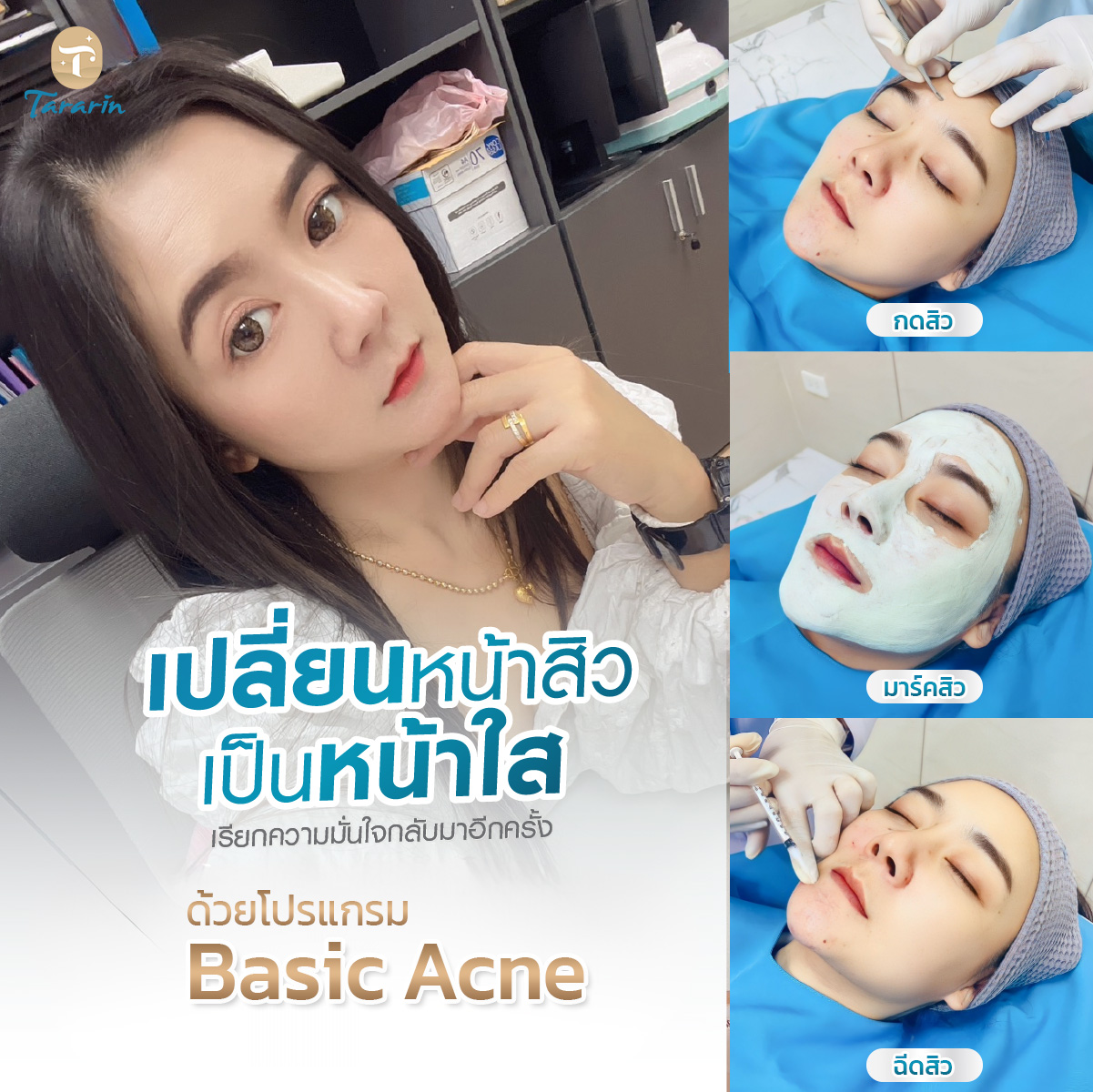 รักษาสิว BASIC ACNE โปรแกรมครบจบปัญหาสิว