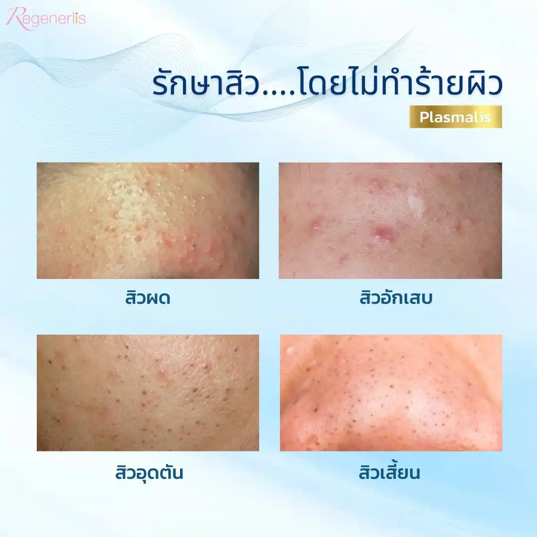 ผลลัพธ์การรักษาสิว ก่อน-หลัง Plasmalis