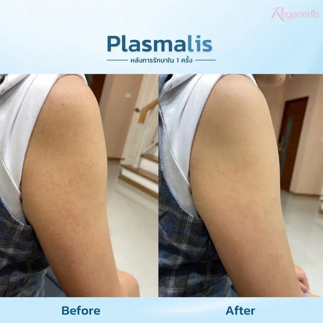 ผลลัพธ์การรักษาสิวผด ก่อน-หลัง Plasmalis