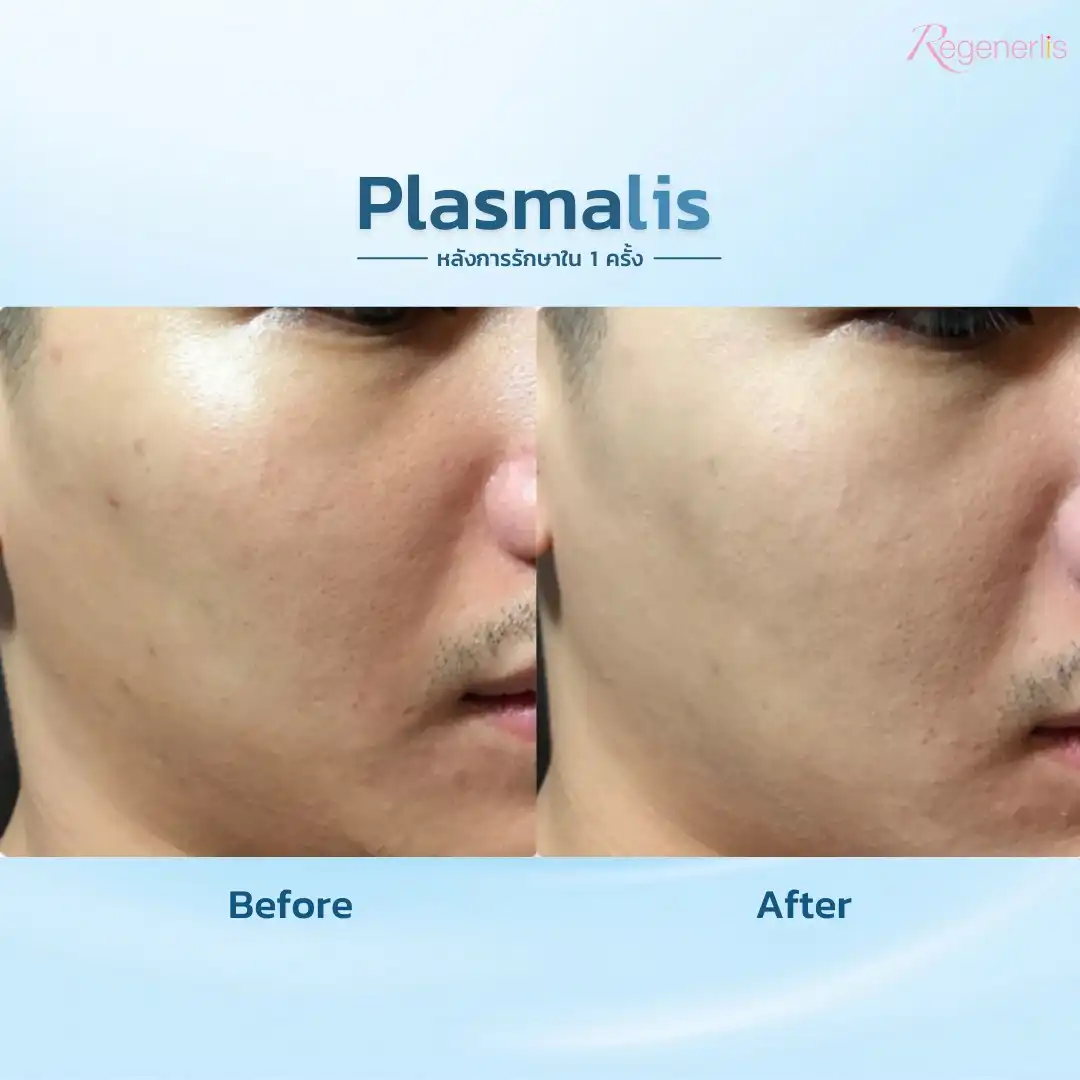 ผลลัพธ์การรักษารอยดำสิว ก่อน-หลัง Plasmalis