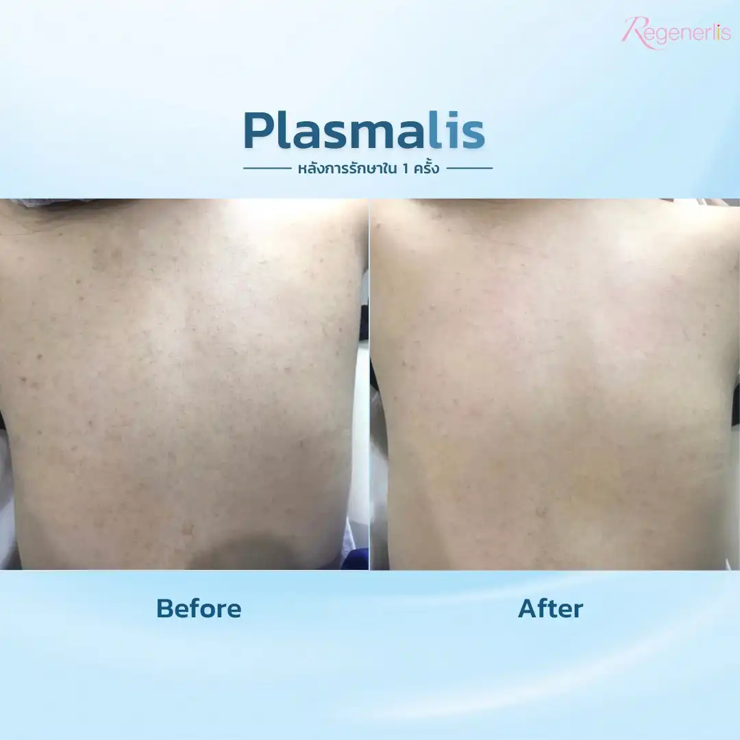 ผลลัพธ์การรักษาสิวที่หลัง ก่อน-หลัง Plasmalis