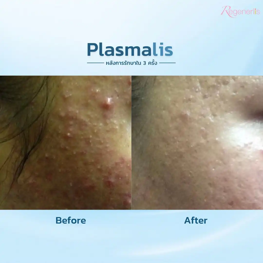 ผลลัพธ์การรักษาสิวอักเสบ ก่อน-หลัง Plasmalis