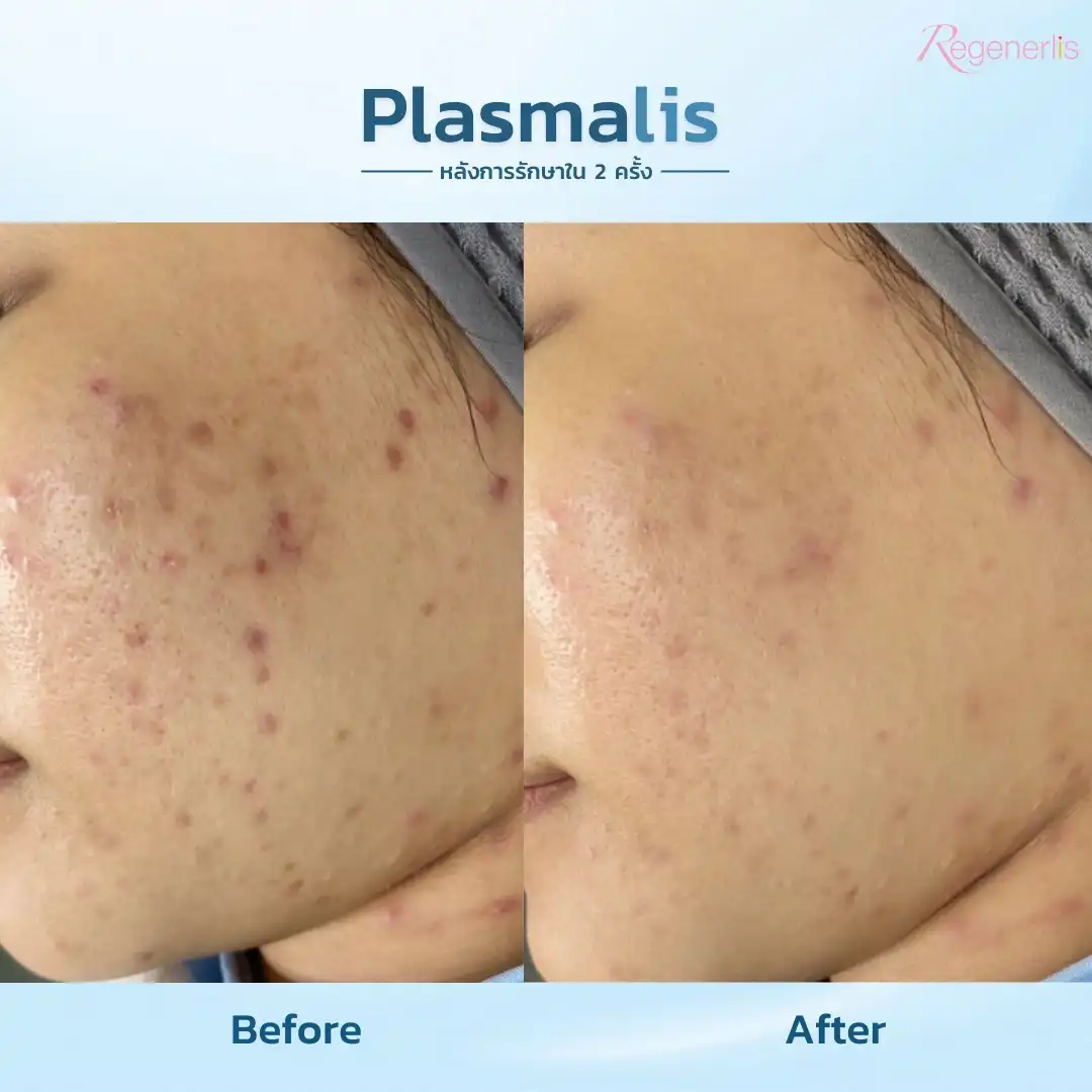 ผลลัพธ์การรักษาสิวอักเสบ ก่อน-หลัง Plasmalis