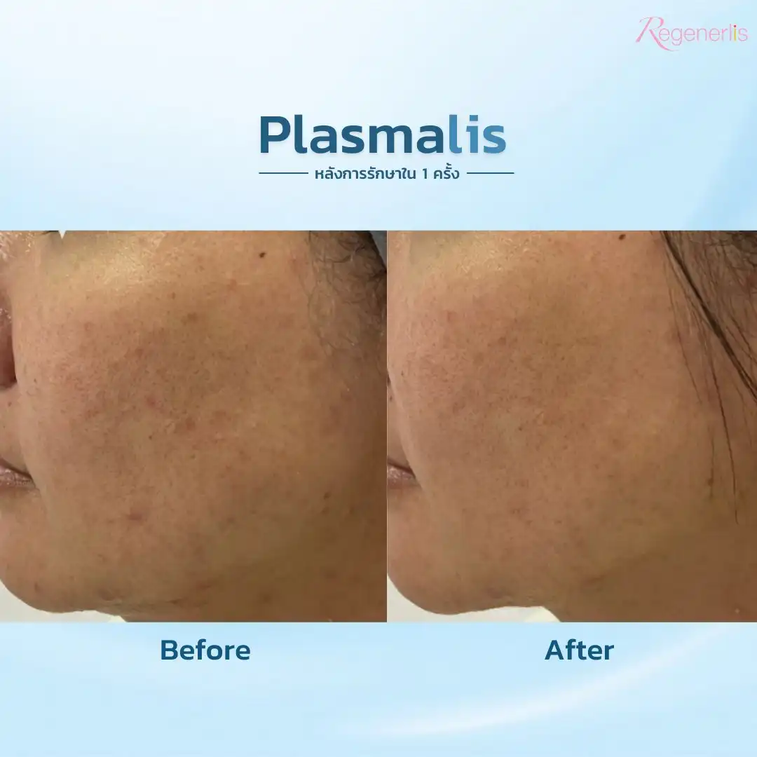 ผลลัพธ์การรักษารอยสิว ก่อน-หลัง Plasmalis