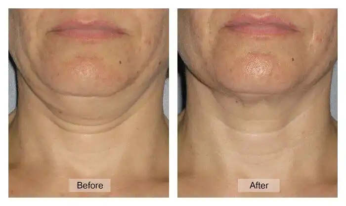 รีวิวการทำ Ulthera ใต้คาง ก่อนหลัง