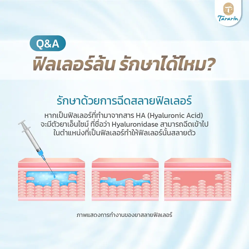 วิธีป้องกัน Filler Face Syndrome ด้วยการเลือกแพทย์ที่มีประสบการณ์