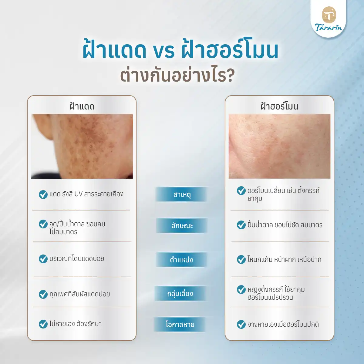 ฝ้าฮอร์โมน ลักษณะและสาเหตุ