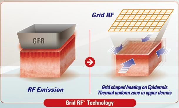 GFRTM Grid Fractional RF ปล่อยคลื่นวิทยุเป็นตารางยกกระชับ