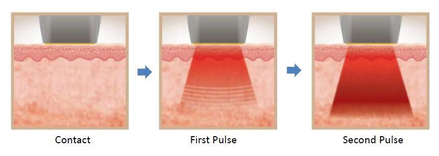 Multi-Pulse ปล่อยคลื่นวิทยุหลายจังหวะเพื่อส่งพลังงานลึก