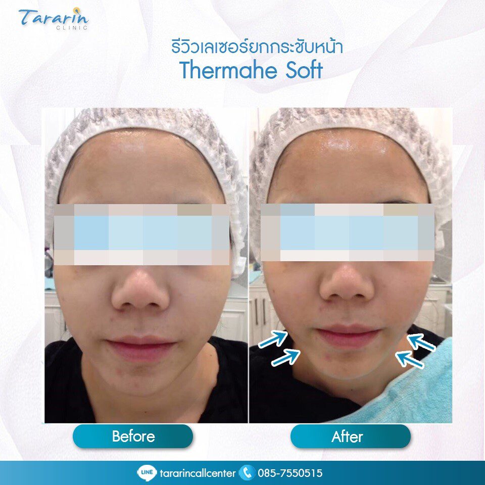 ภาพก่อนและหลัง Thermage Soft ยกกระชับหน้า
