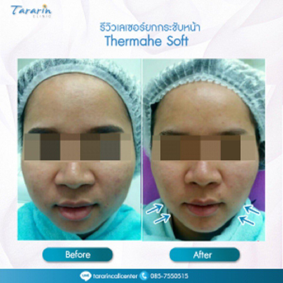 รีวิว Thermage Soft ผิวเรียวงาม