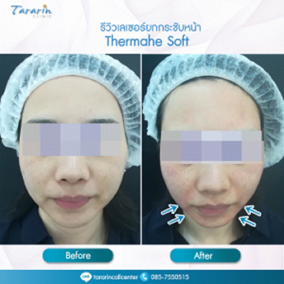 รีวิว Thermage Soft ยกกระชับผิว