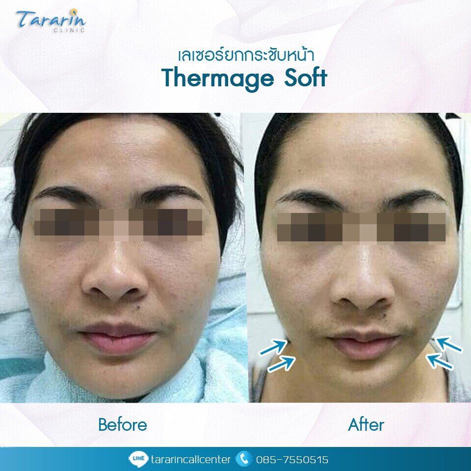 ผลการรักษา Thermage Soft ปรับรูปหน้า