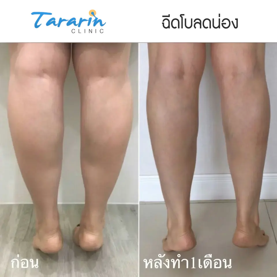 รีวิวฉีดโบทูลินัม ลดกราม ปรับหน้าเรียว ผลลัพธ์จริง