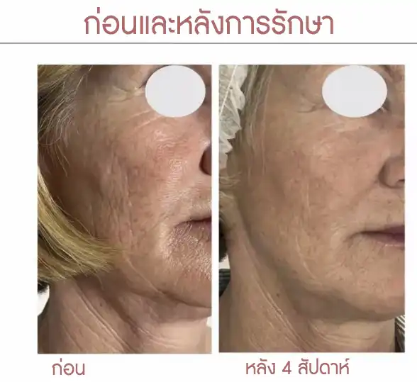 ผลการฉีด Gouri กระตุ้นคอลลาเจน ผิวอ่อนเยาว์