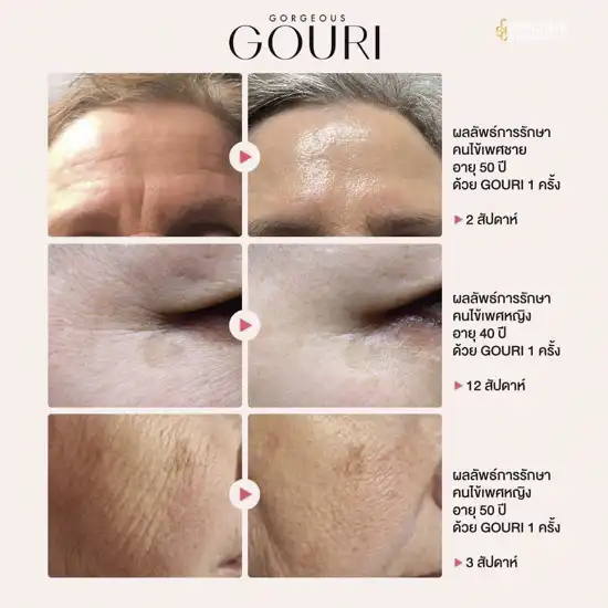 ตัวอย่างผลลัพธ์ Gouri ก่อนหลัง ผิวฟูเต่งตึง