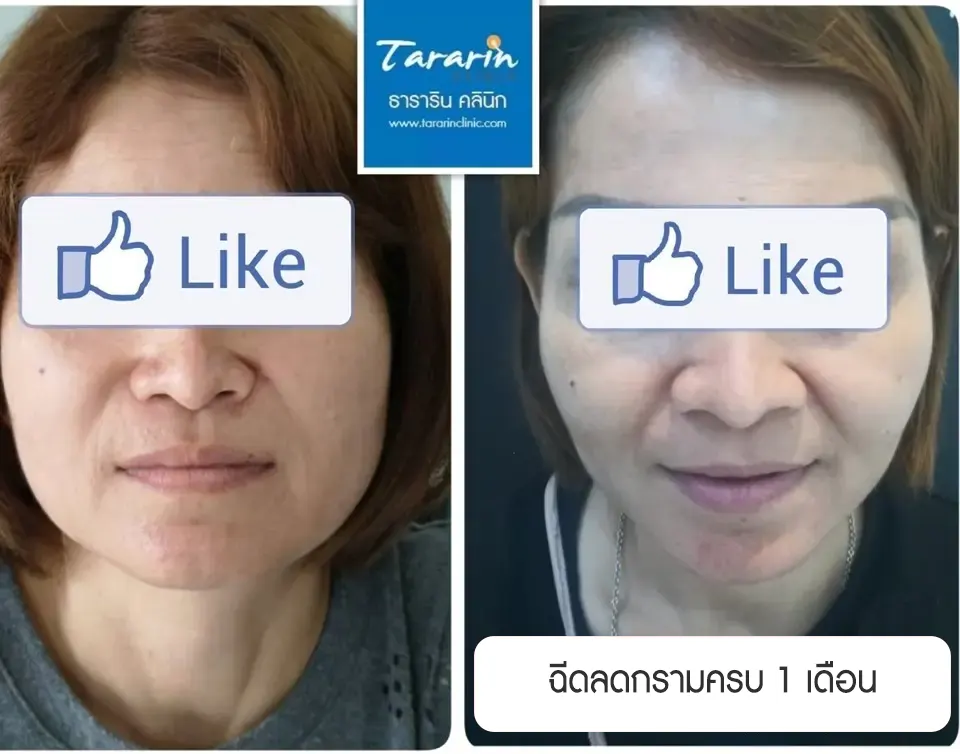 รีวิวฉีดโบลดกราม ปรับรูปหน้าเรียว ก่อน-หลัง ธารารินคลินิก