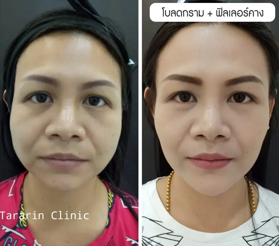 ฉีดโบลดกราม ลิฟกรอบหน้าช่วยปรับหน้าเรียว ลดริ้วรอย