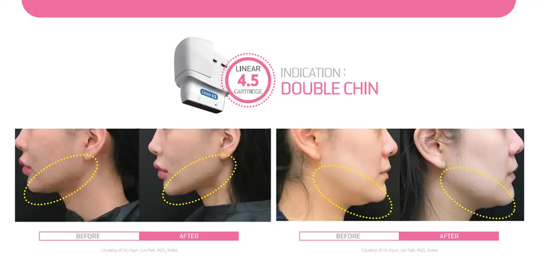 Linear HIFU ปรับหน้าเรียว V ไลน์ กรอบหน้าชัด