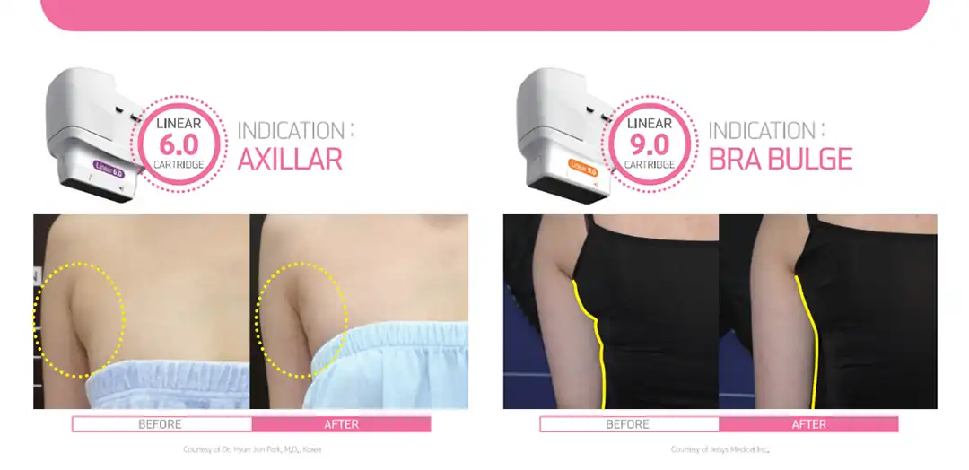 Linear HIFU ลดเหนียง คางสองชั้น