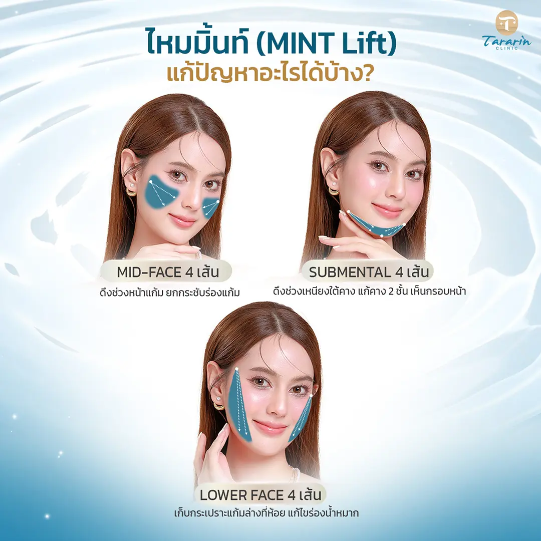 ผลลัพธ์การร้อยไหม MINT LIFT ยกกระชับผิวหน้าให้กระชับตึง