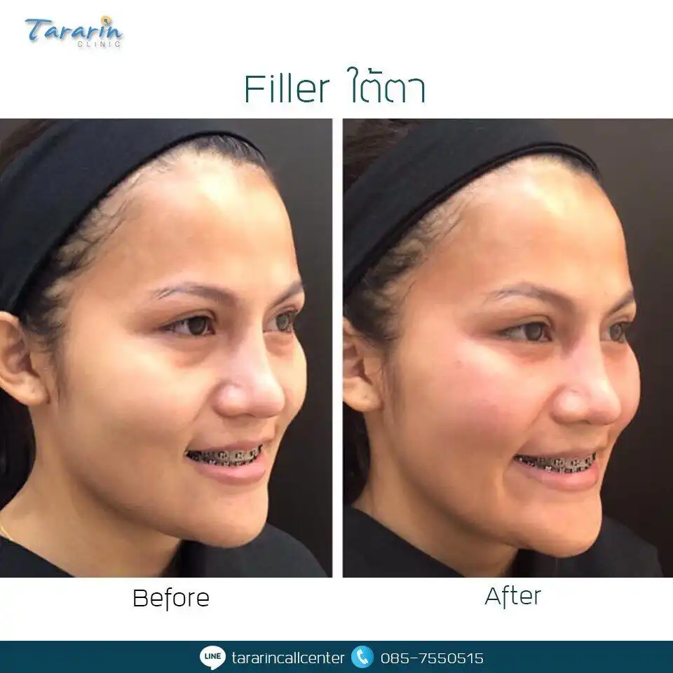 รีวิวฉีดฟิลเลอร์ใต้ตา ก่อนหลัง