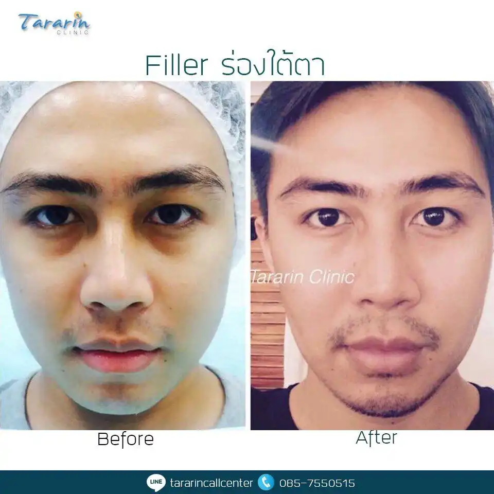 รีวิวฉีดฟิลเลอร์ใต้ตา แก้ปัญหาร่องใต้ตาลึก ตาคล้ำ