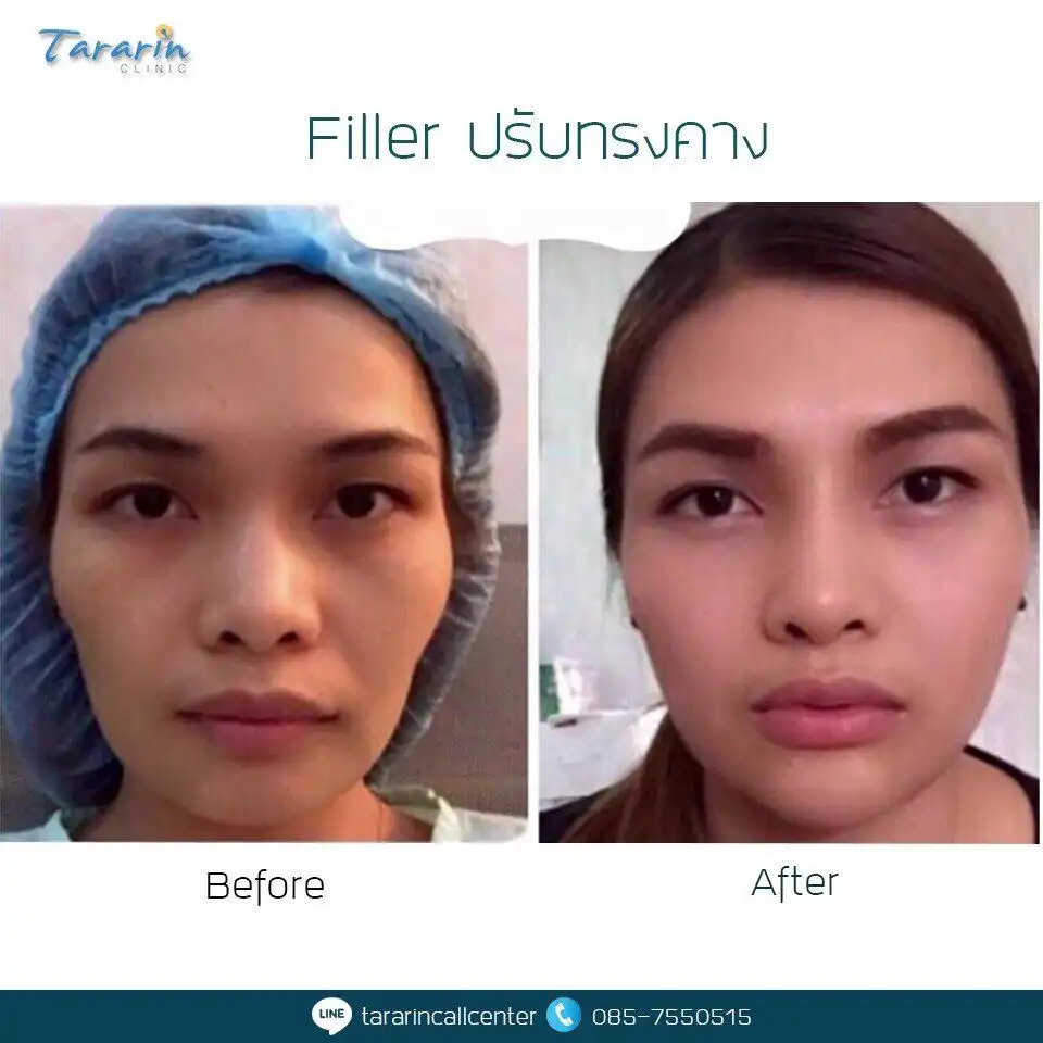 รีวิวฉีดฟิลเลอร์คาง ปรับรูปหน้า Juvederm