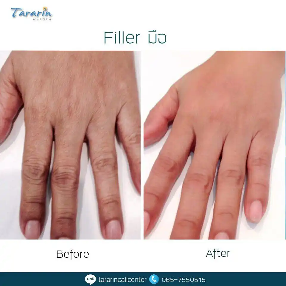 รีวิวฉีดฟิลเลอร์มือ เพิ่มความชุ่มชื้น