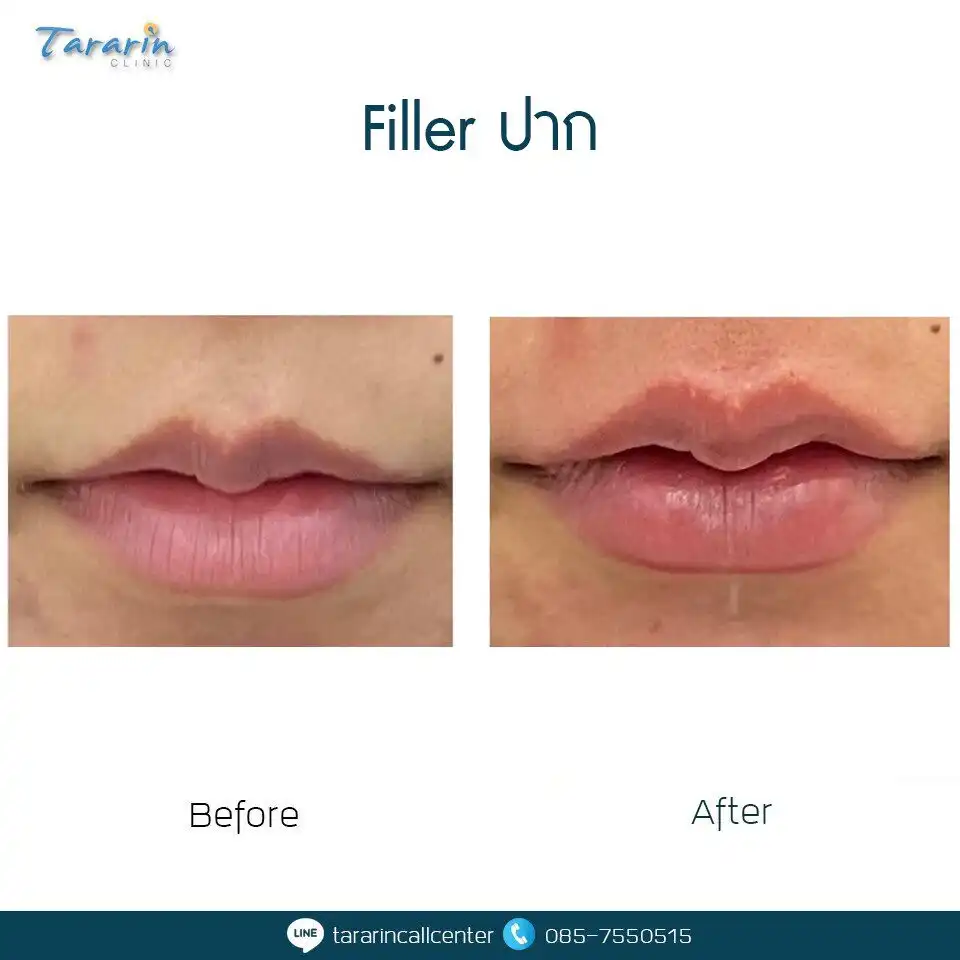 รีวิวฉีดฟิลเลอร์ปาก ปากกระจับ อวบอิ่ม