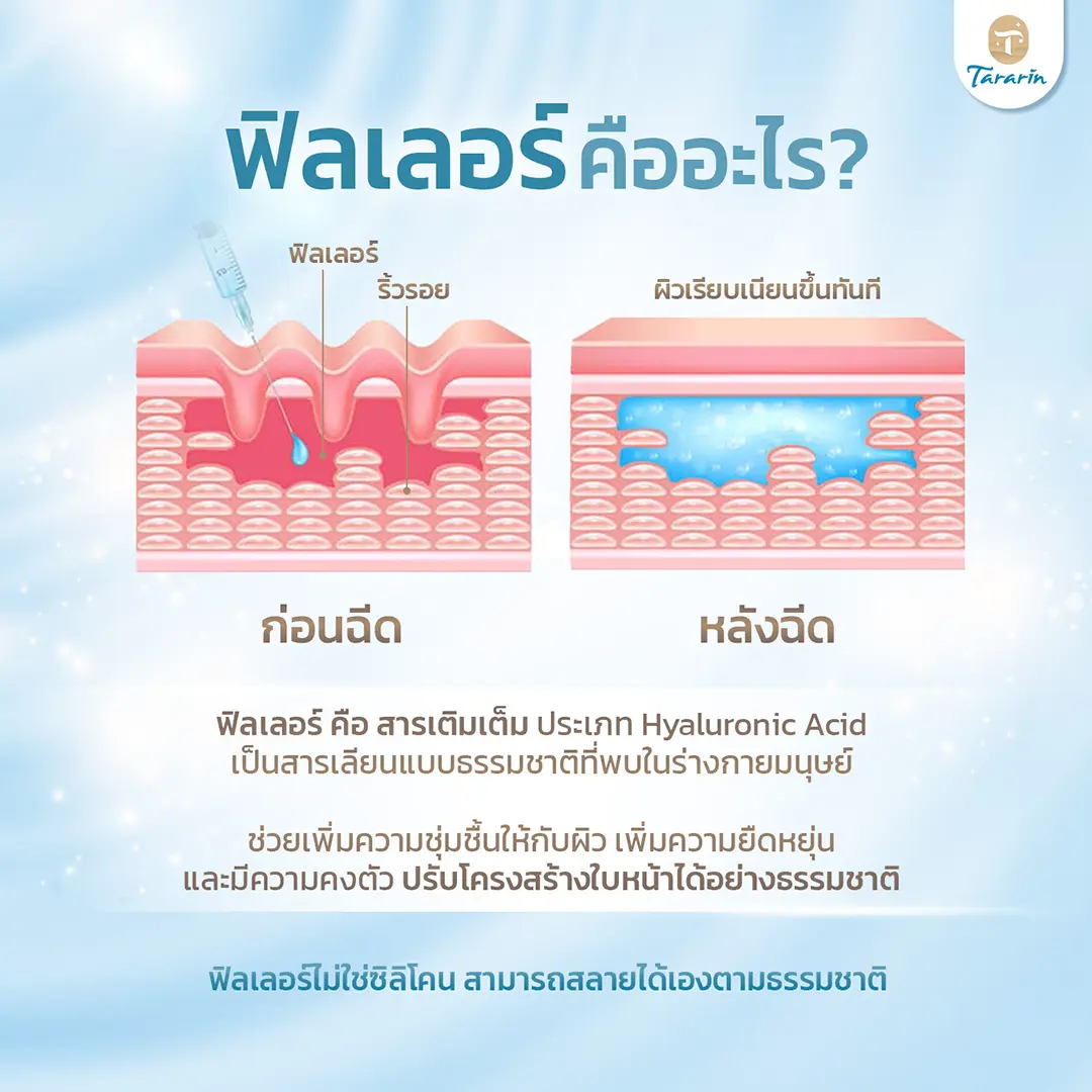 ทำความรู้จักฟิลเลอร์คืออะไร สารเติมเต็ม ฮายาลูโรนิคแอซิด เพิ่มปริมาตรใบหน้า