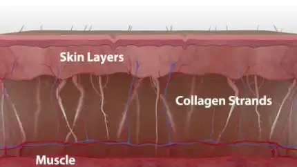 หลักการทำงาน Thermage FLX ขั้นตอนที่ 1 คอลลาเจนเสื่อมสภาพตามอายุ