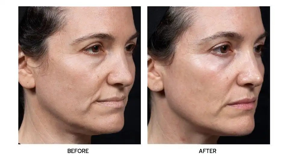 รีวิว Thermage FLX บริเวณใบหน้า รอบปาก ตา หน้าผาก กรามและใต้คาง