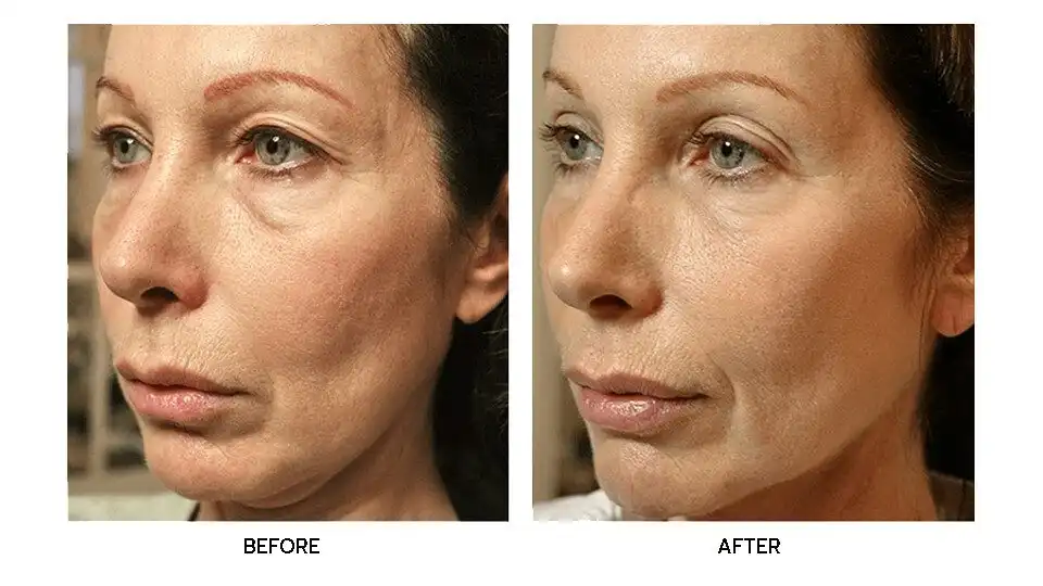 รีวิว Thermage FLX บริเวณใบหน้า รอบปาก ตา หน้าผาก เพิ่มความคมชัดบริเวณกรามและใต้คาง