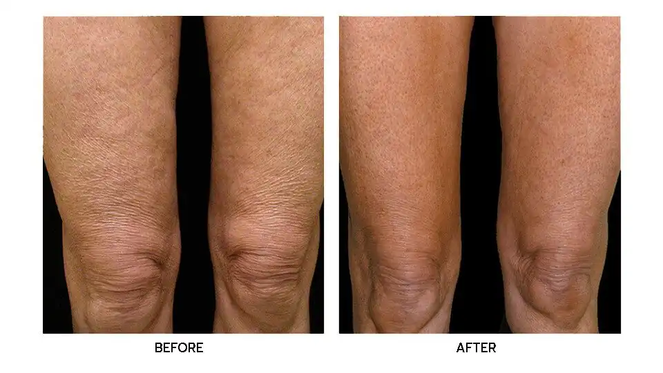 รีวิว Thermage FLX Body บริเวณขา ยกกระชับขาเรียว