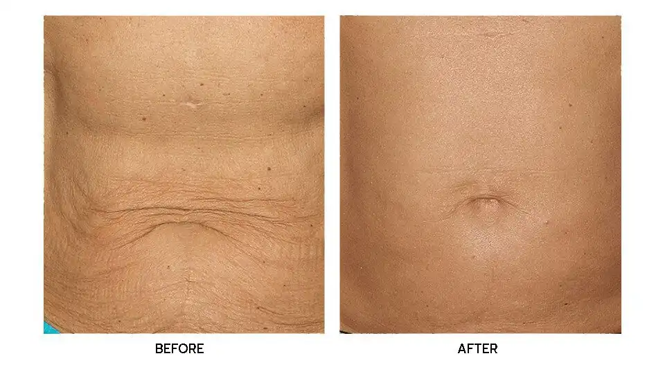 รีวิว Thermage FLX Body บริเวณหน้าท้อง ลดหน้าท้องกระชับเรียว