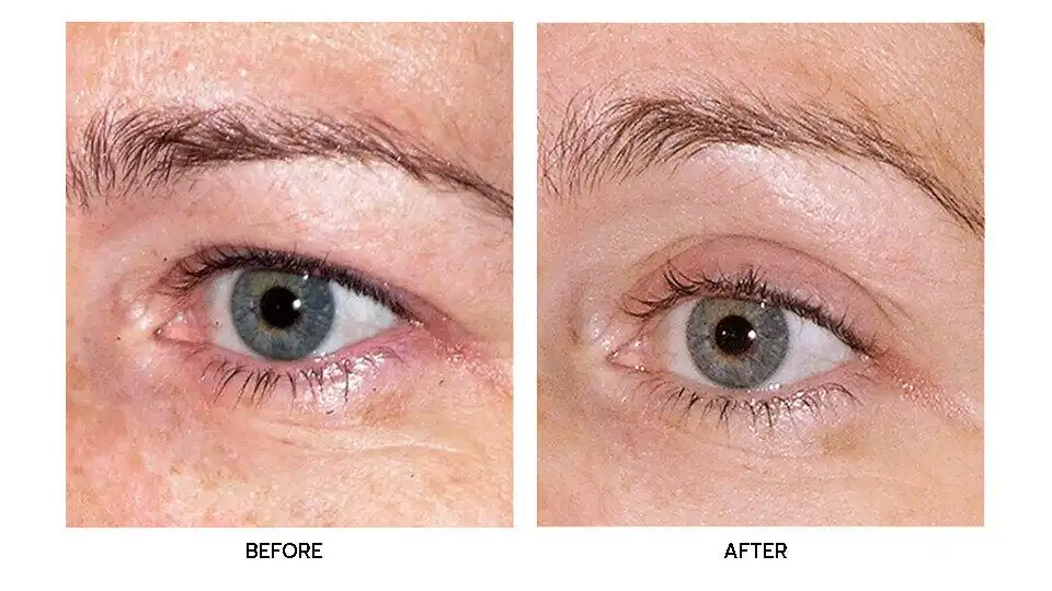 รีวิว Thermage FLX Eyes บริเวณรอบตา ลดเลือนริ้วรอยแลดูตื้นขึ้น