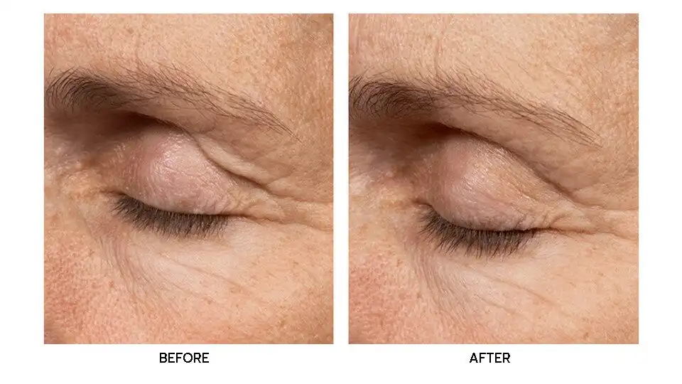 รีวิว Thermage FLX Eyes บริเวณคิ้วหางตา ช่วยลดเลือนริ้วรอยแลดูตื้นขึ้น