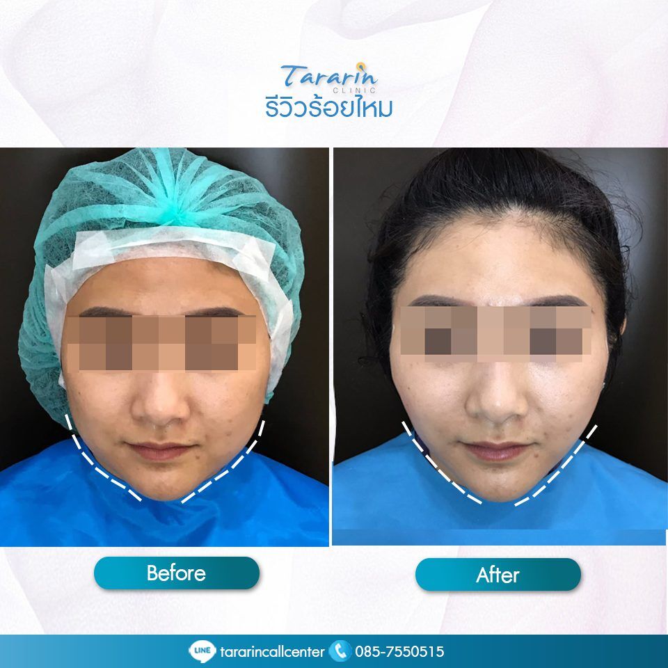 รีวิวร้อยไหม Thread Lift ยกกระชับหน้าผลลัพธ์จริง 1