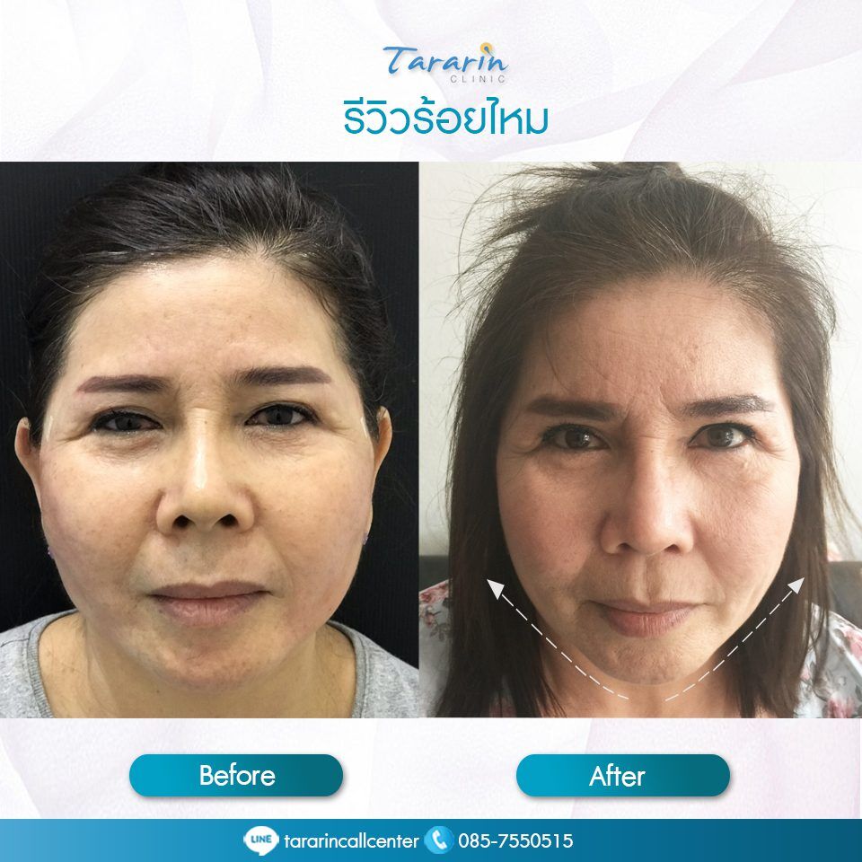 รีวิวร้อยไหมมิ้นท์ MINT LIFT ผลลัพธ์ก่อนหลัง 2