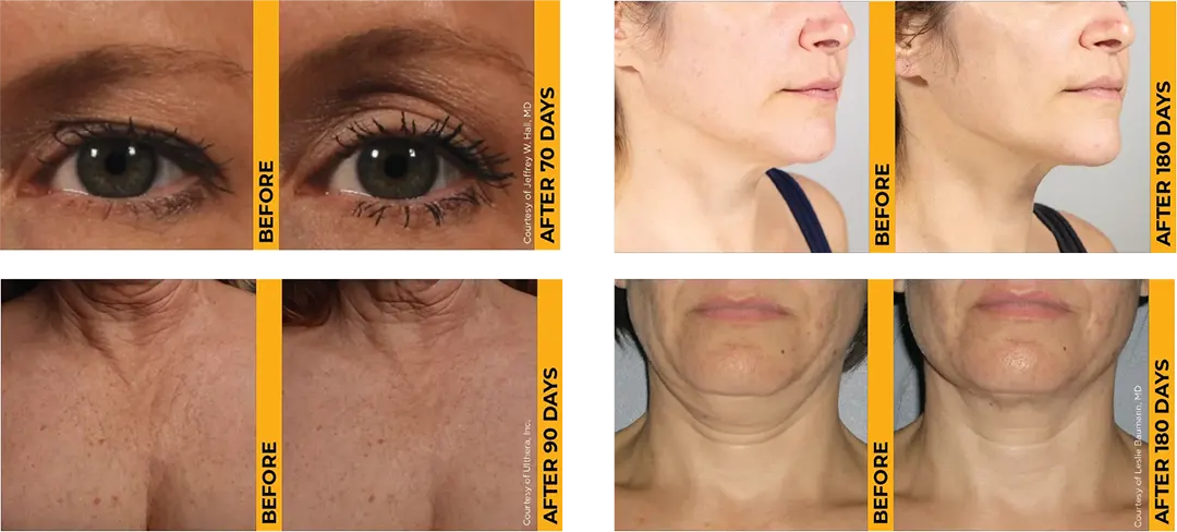 ผลลัพธ์ Ulthera Prime ยกกระชับหน้าและลำคอ Before After
