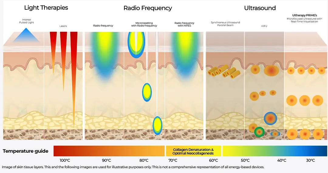 เปรียบเทียบความลึกการเข้าถึงชั้นผิว HIFU อัลตราซาวนด์ RF Light Therapies