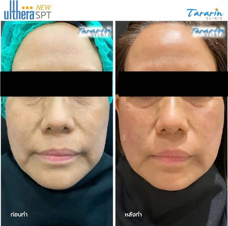 รีวิว New Ulthera SPT ยกกระชับผิวหน้า ผลลัพธ์จริง