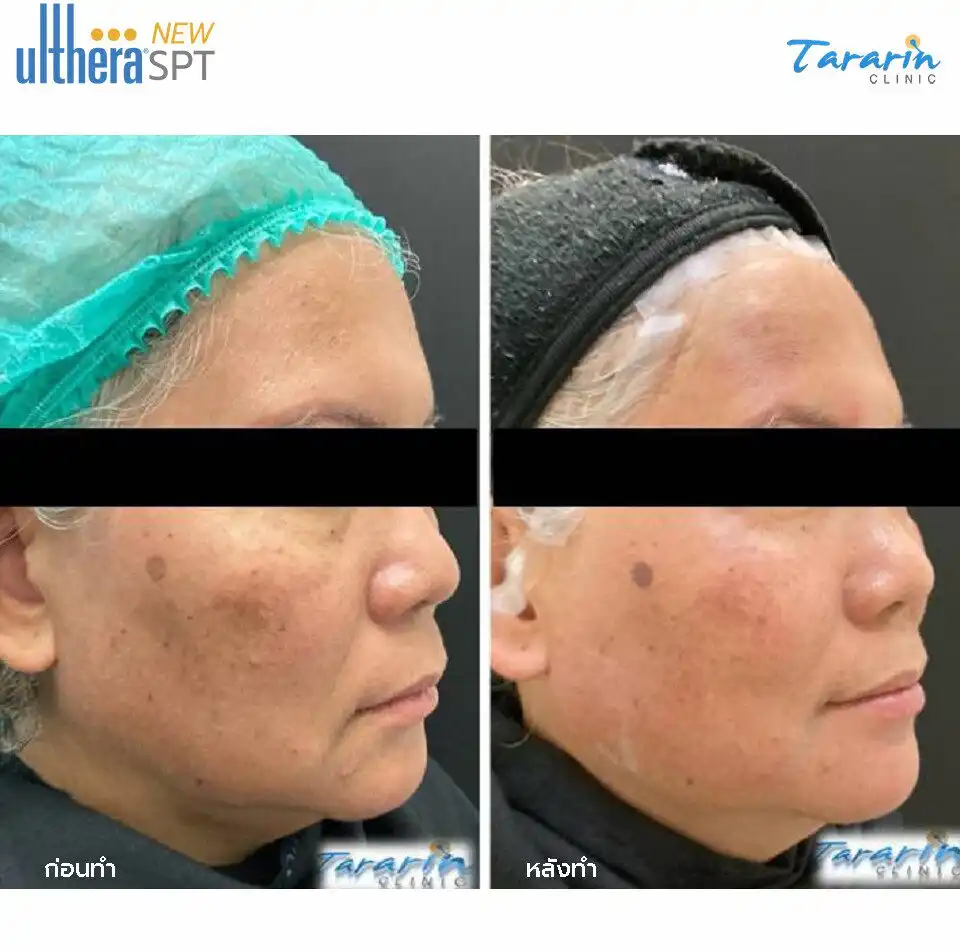 รีวิว New Ulthera SPT กรอบหน้าชัดเจน