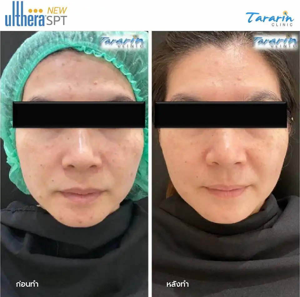 รีวิว New Ulthera SPT ผิวเต่งตึงใส
