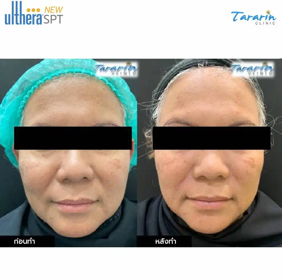 รีวิว New Ulthera SPT ลดเหนียง คางสองชั้น