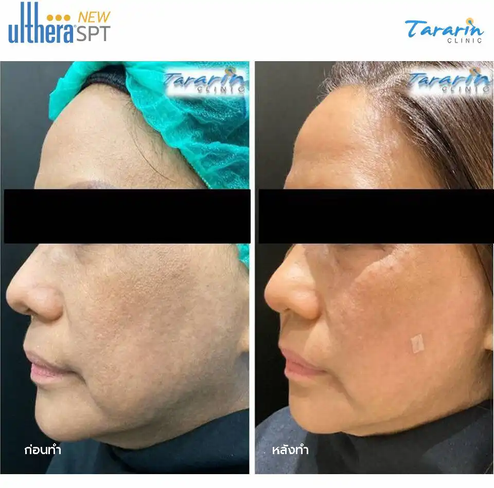 รีวิว New Ulthera SPT ดูอ่อนเยาว์