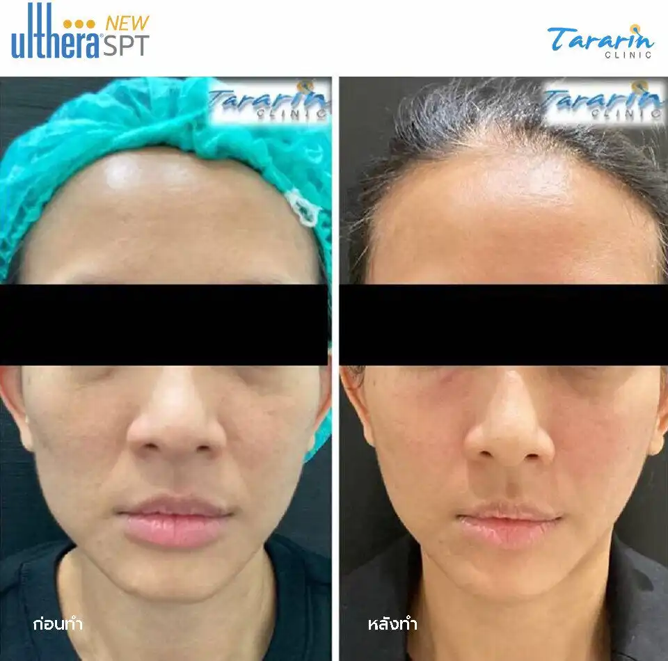 รีวิว New Ulthera SPT ยกกระชับหน้า ขอนแก่น